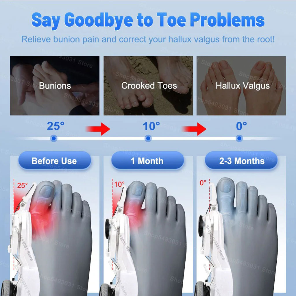 Correcteur Hallux Valgus pour Femme et Homme avec Molette Réglable – مصحح وضعية القدم